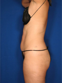 Patient # 32160 After Photo # 4